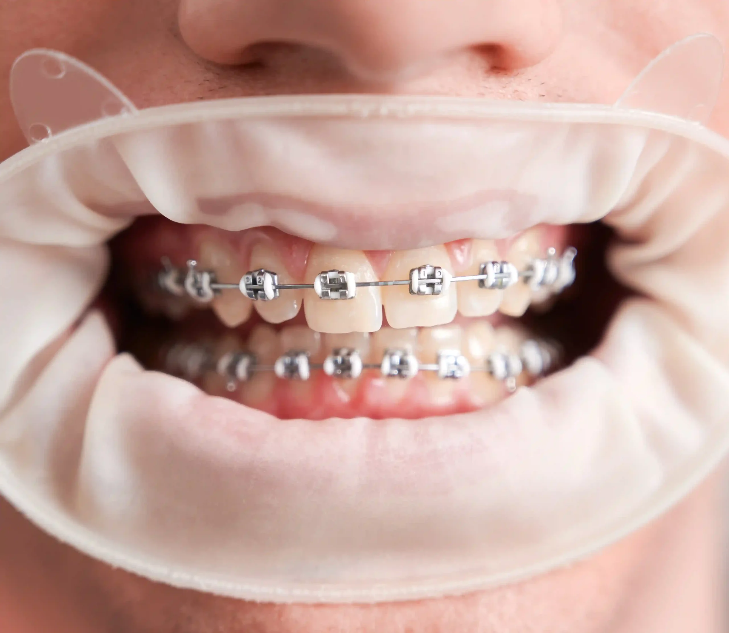 Early Orthodontic Care for Kids: What Parents in Dubai Need to Know