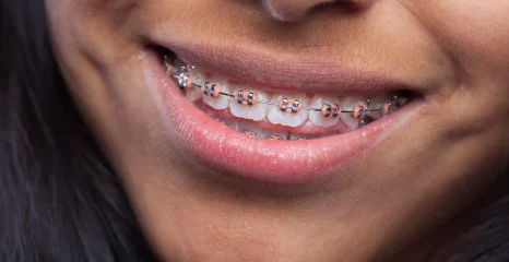 Orthodontic Treatments in Dubai: Straightening Your Smile with Ease