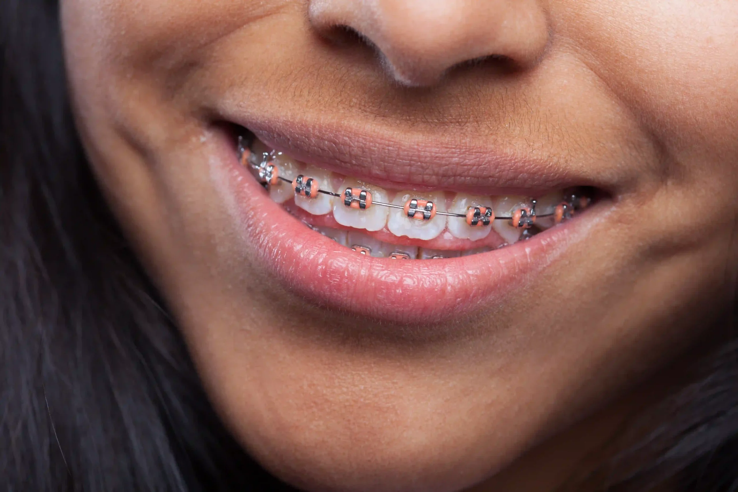 Orthodontic Treatments in Dubai: Straightening Your Smile with Ease